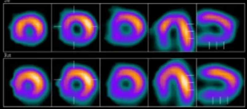 Imagens de cintilografia miocárdica em cortes transversais, comparando o fluxo de sangue no coração em repouso e sob estresse