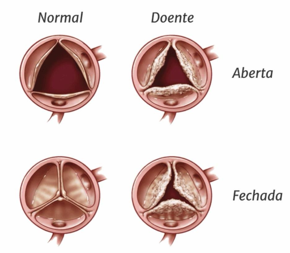 Ilustração comparando a válvula aórtica normal e a válvula doente com estenose, nas posições aberta e fechada